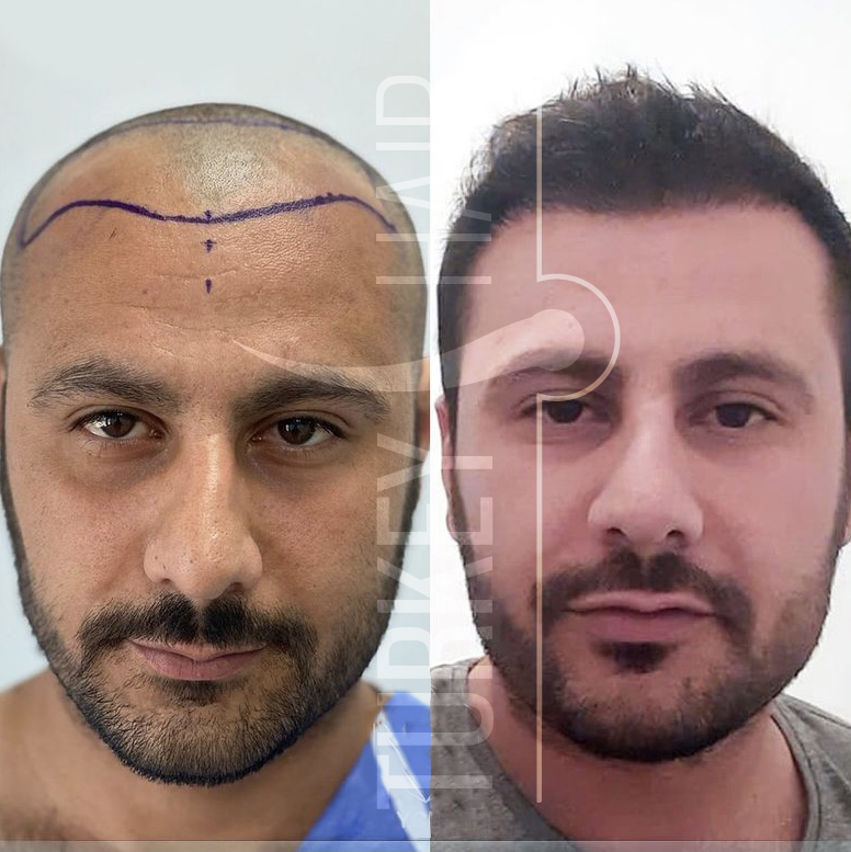 Turkey Hair Transplant Turkey Hair Center 4650